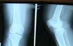 Как проводится рентген коленного сустава, и что он показывает?