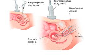 Métodos invasivos - obstetricia